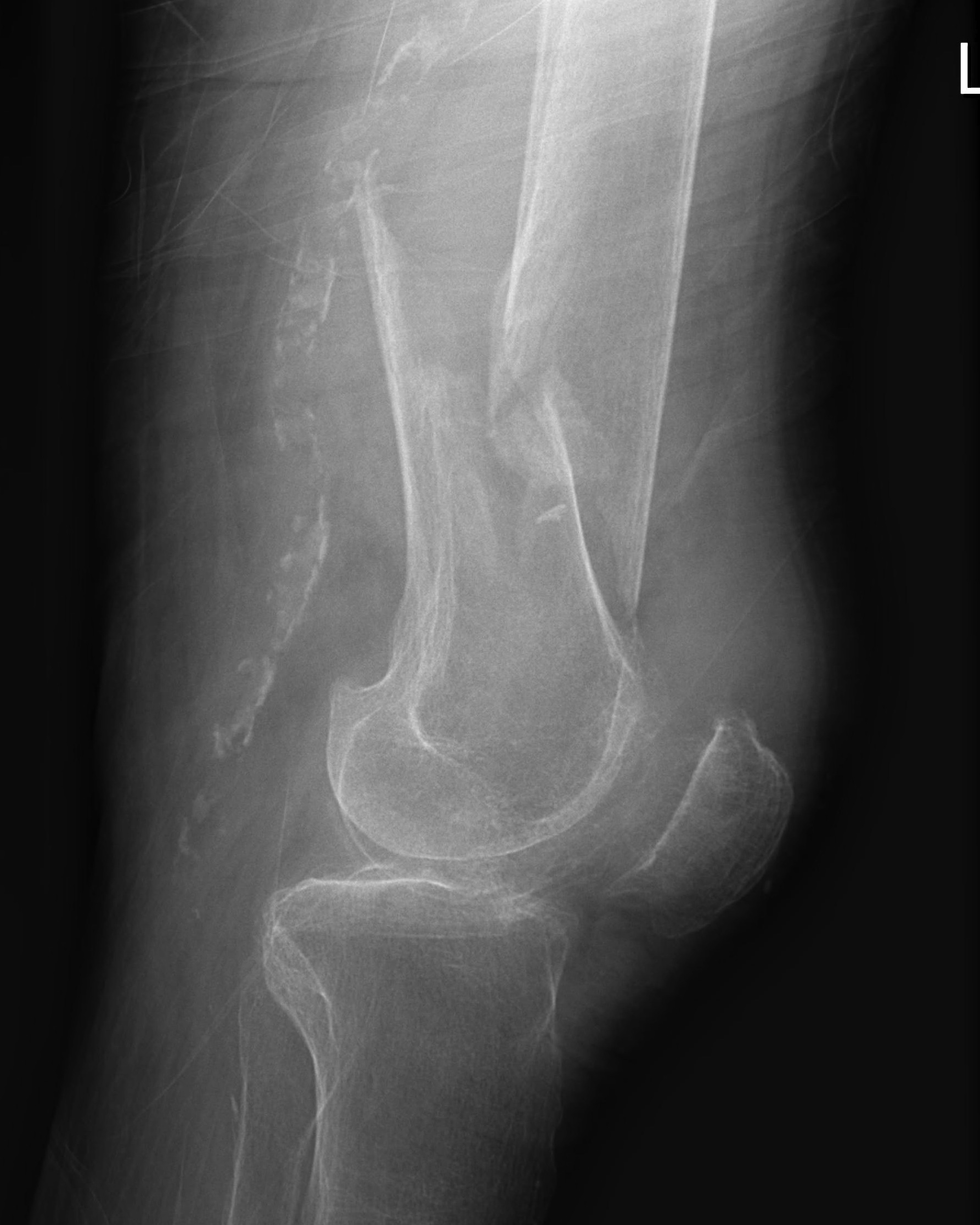 Distal Femur Fracture Lateral